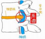 ヘルニアイラスト